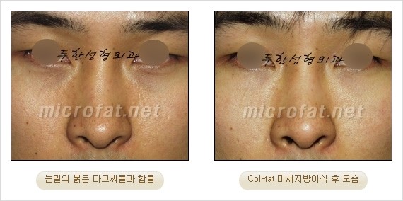 [두한성형외과 경쟁력 눈밑성형] - [Dr. 컬럼 - 눈밑 다크써클의 치료 방법과 치료 효과] 관련 이미지 10