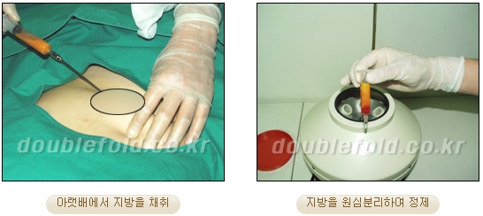 [Duhan Plastic Surgery Revision Double Eyelid Surgery] - [Double Eyelid Revision Surgery Process] image 31