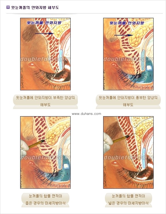 [두한성형외과 NO.1 눈성형] - [함몰된(꺼진) 눈꺼풀에서 쌍꺼풀 라인 교정 1.] 관련 이미지 3