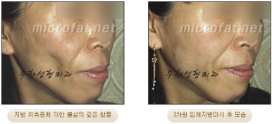 [두한성형외과 얼굴지방이식] - [볼지방이식] 관련 이미지 23