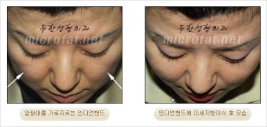[Facial Autologous Fat Grafting, Duhan Plastic Surgery] - [Indian Wrinkle] image 11