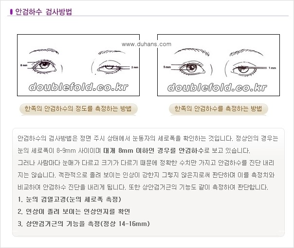 [두한성형외과 NO.1 "극한 눈(쌍꺼풀 재수술)"] - [안검하수(졸린눈매) 재수술 안내 2.] 관련 이미지 2