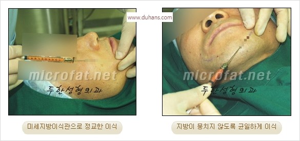 [두한성형외과 경쟁력 안면윤곽 교정] - [자연스럽고 균형있는 턱으로의 복원 미세지방이식과 간편 사각턱 보톡스 안내] 관련 이미지 33
