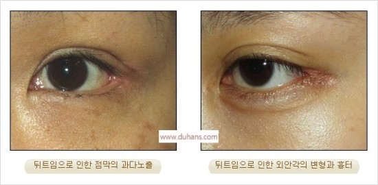 ​[두한성형외과 경쟁력 눈매성형] - [눈의 가로길이를 키우는 앞트임, 뒤트임 수술] 관련 이미지 30