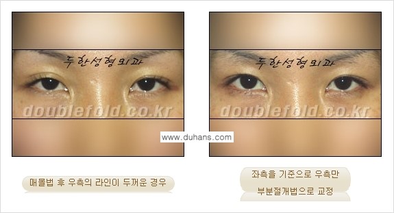 [두한성형외과 경쟁력 쌍꺼풀 재수술] - [비대칭(짝짝이) 쌍꺼풀 라인 교정하는 방법 안내 ①] 관련 이미지 3