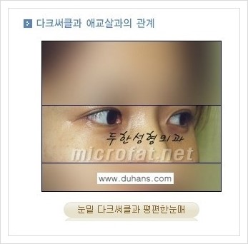 [두한성형외과 경쟁력 눈밑성형] - [애교살과 다크써클과의 관계] 관련 이미지 4