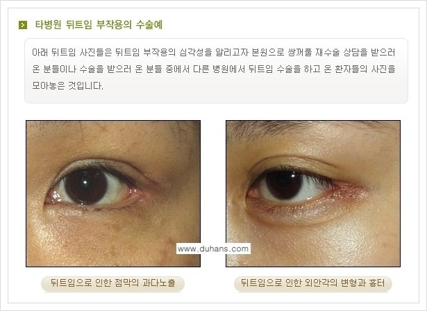 [두한성형외과 경쟁력 눈성형] - [앞트임 복원수술, 뒤트임 복원수술 안내] 관련 이미지 5