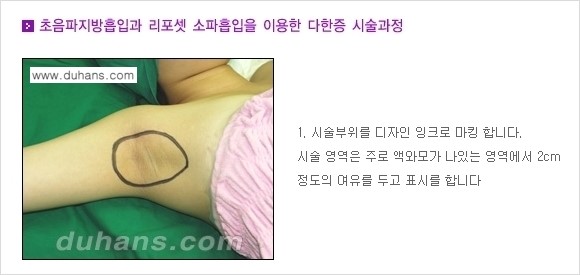 [두한성형외과 성형 FOCUS 지방흡입] - [액취증 - 다한증 초음파 컷터 지방흡입 ④] 관련 이미지 2