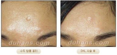 Duhan Plastic Surgery Scar Treatment - Improvement of Chickenpox Scars, Acne Scars, and Depressed Scars image 10