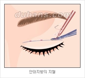 [두한성형외과 경쟁력 눈성형 리더] - [아름다운 눈매를 위한 쌍꺼풀 수술 안내] 관련 이미지 9