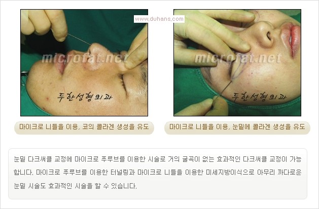 [두한성형외과 경쟁력 눈밑성형] - [다크써클 증상과 증상에 맞는 치료 방법] 관련 이미지 46