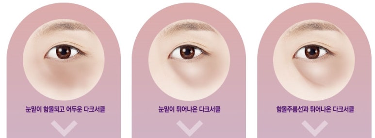 두한성형외과 눈밑수술 - 다크서클 수술 전후 관리 안내 관련 이미지 111