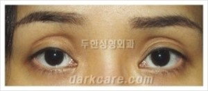 [두한성형외과 경쟁력 눈밑성형] - [다크써클 수술 동시 콤비 프로그램 안내] 관련 이미지 3