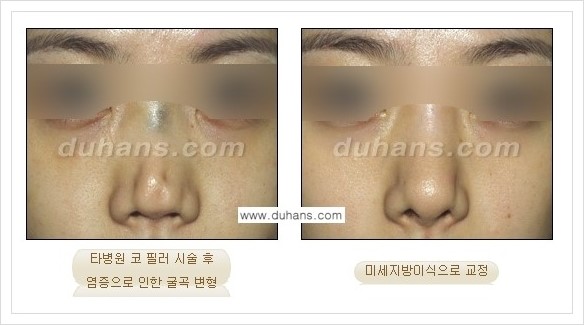 [두한성형외과 경쟁력 코성형] - [자연스러운 코 미세지방이식] 관련 이미지 7