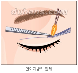 쌍커풀수술 두한성형외과 - 나에게 맞는 눈성형은? 관련 이미지 23