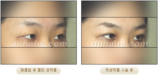 [Duhan Plastic Surgery Double Eyelid Surgery] - [Types of Double Eyelid Surgery] image 23