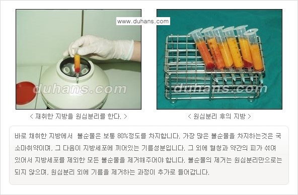 [두한성형외과 경쟁력 미세지방이식] - [코 지방이식 1.] 관련 이미지 7