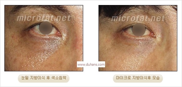 [두한성형외과 경쟁력 미세지방이식] - [지방이식 부작용 교정 모습 안내] 관련 이미지 31