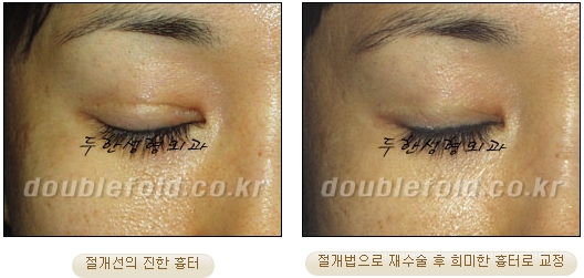 [Duhan Plastic Surgery Eye Surgery] - [Double Eyelid Scar, Double Eyelid Scar Tissue, Revision Surgery for Pigeon Eyes and Ptosis Correction] image 17