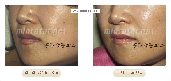 [두한성형외과 경쟁력 주름성형] - [입가주름과 코옆 팔자주름제거 지방이식 시술의 효과] 관련 이미지 14