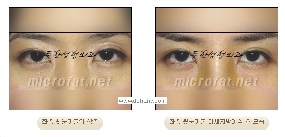 [두한성형외과 경쟁력 미세지방이식] - [꺼진(함몰된) 윗눈꺼풀 미세지방이식] 관련 이미지 17