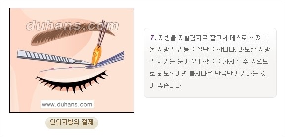 [두한성형외과 경쟁력 눈성형] - [쌍꺼풀 재수술 방법 - 부분절개법(Partial incision method) 과정 안내] 관련 이미지 8