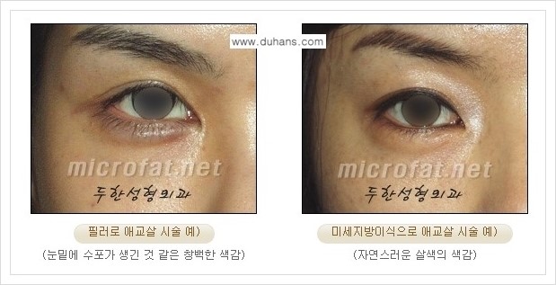 [두한성형외과 경쟁력 눈밑성형] - [눈밑 다크써클과 눈밑 애교살과의 관계] 관련 이미지 13