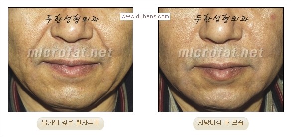 [두한성형외과 경쟁력 주름성형] - [코 옆과 입가에 걸쳐서 형성된 주름을 교정해주는 미세지방이식] 관련 이미지 12