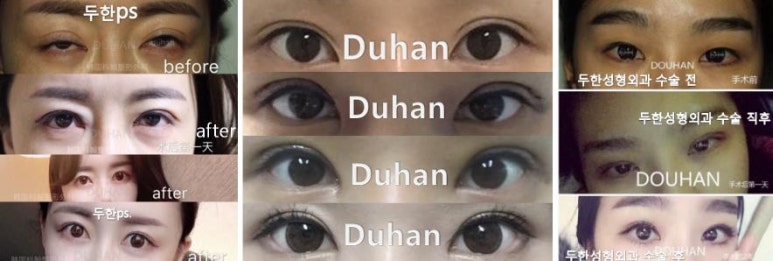 Best Place for Revision Eyelid Surgery, Duhan Plastic Surgery - Lowering Double Eyelid Line image 40