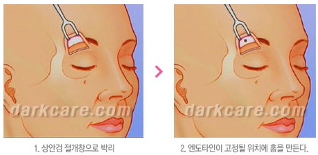 Duhan Plastic Surgery Combo Program - Dark Circles and Lifting image 28