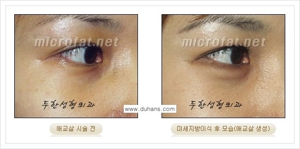 [두한성형외과 경쟁력 눈밑성형] - [눈밑 애교살 미세지방이식 안내] 관련 이미지 3