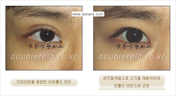 [두한성형외과] - [아웃폴드를 인폴드로 변화시키는 쌍꺼풀재수술] 관련 이미지 9