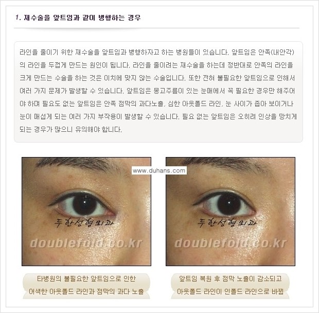 [두한성형외과 경쟁력 쌍꺼풀 재수술, 극한 재수술] - [쌍꺼풀 재수술 실패 원인(Cause of reoperation fail) 안내] 관련 이미지 1