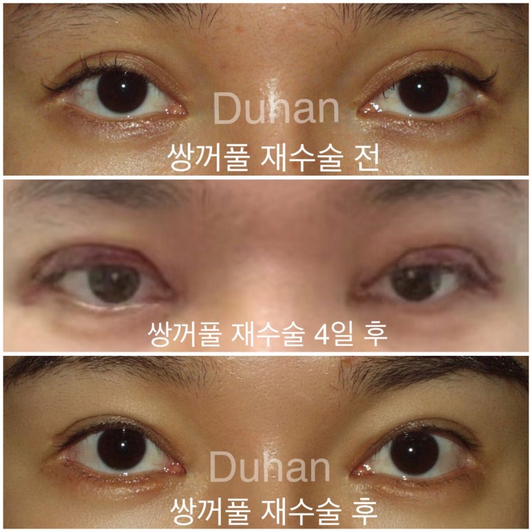 I Had Double Eyelid Revision Surgery at Duhan~~~ image 1