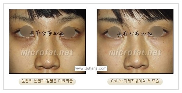 [두한성형외과 경쟁력 눈밑성형] - [눈밑 다크써클과 눈밑 함몰주름의 최적화 교정방법 안내] 관련 이미지 12