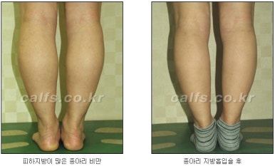 ​[두한성형외과 종아리수술] - [나에게 맞는 종아리성형방법] 관련 이미지 32