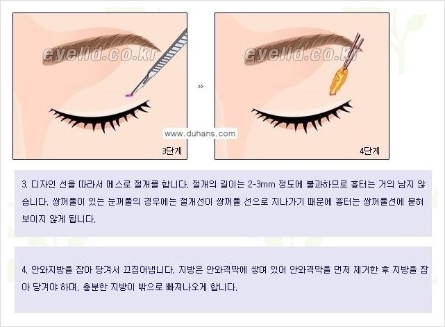 [두한성형외과 경쟁력 눈성형] - [윗눈꺼풀 지방제거 방법 안내] 관련 이미지 4