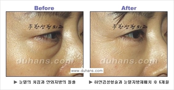 [두한성형외과의 상큼하고 환한 젊은 눈매완성] - [하안검 성형술 ①] 관련 이미지 10