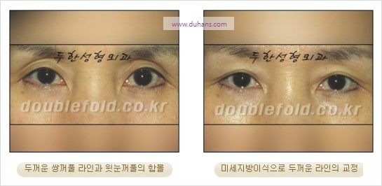 [두한성형외과 경쟁력 눈성형] - [쌍꺼풀 재수술 과정과 쌍꺼풀 재수술 실패의 원인, 쌍꺼풀 재수술의 성공 요건] 관련 이미지 27