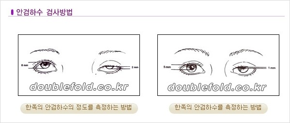 [두한성형외과 경﻿쟁력 눈성형] - [안검하수(졸린눈매) 종류와 교정 수술 안내] 관련 이미지 2