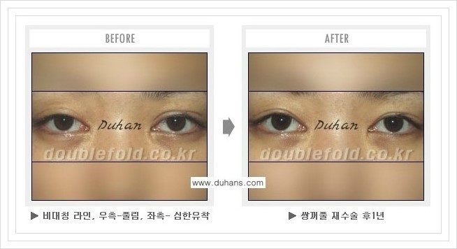 [두한성형외과 경쟁력 쌍꺼풀 재수술, 극한 재수술] - [여러번의 재수술로 인해 흉살이 두터운 경우 교정 방법 안내] 관련 이미지 7