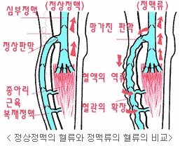 [두한성형외과 정맥류] - [정맥류의 원인과 문제점] 관련 이미지 7