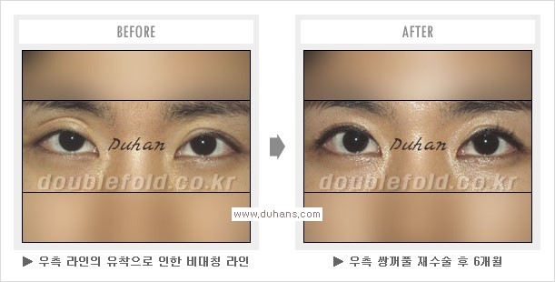 [두한성형외과 경쟁력 쌍꺼풀 재수술, 극한 눈재수술] - [망친 쌍꺼풀, 망가진 쌍꺼풀 복원수술, 재수술의 성공요건] 관련 이미지 11