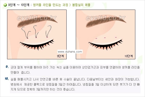 [두한성형외과 성형 FOCUS] - [퀵쌍꺼풀 수술 ③] 관련 이미지 10