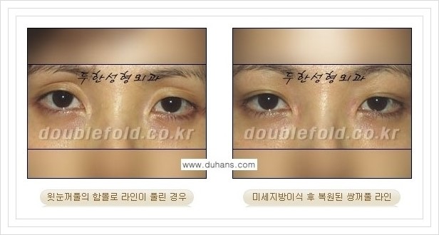 [두한성형외과 경쟁력 눈성형] - [풀린 쌍꺼풀 라인 재수술의 여러 가지 방법 안내] 관련 이미지 11