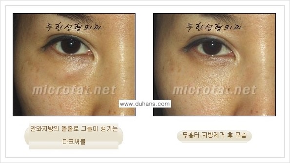 [두한성형외과 경쟁력 눈밑성형] - [눈밑지방제거, 눈위지방제거 안내 1.] 관련 이미지 25