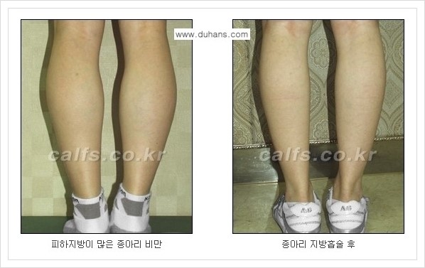 [두한성형외과 경쟁력 멀티종아리성형] - [정교한 미세흡입관 종아리 지방흡입술] 관련 이미지 13