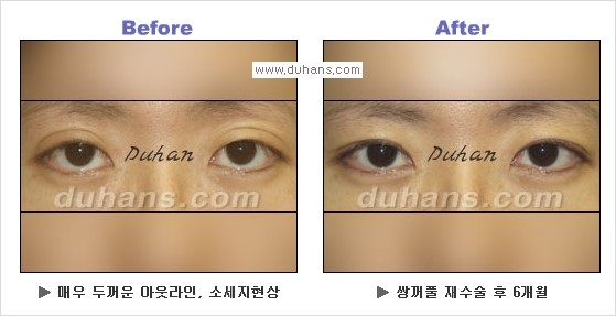 [두한성형외과 경쟁력 눈성형] - [Dr. 컬럼  "어떤 쌍꺼풀이 아름다운 쌍꺼풀인가?!] 관련 이미지 13