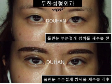 Douhan Plastic Surgery - Revision Double Eyelid Surgery: Outline Revision image 2