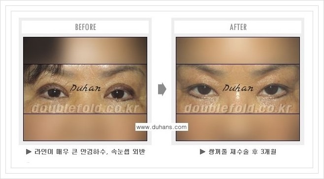 [두한성형외과 경쟁력 쌍꺼풀 재수술, 극한 재수술] - [과한 눈매교정 안내] 관련 이미지 4